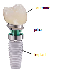 Implant dentaire saint ouen
