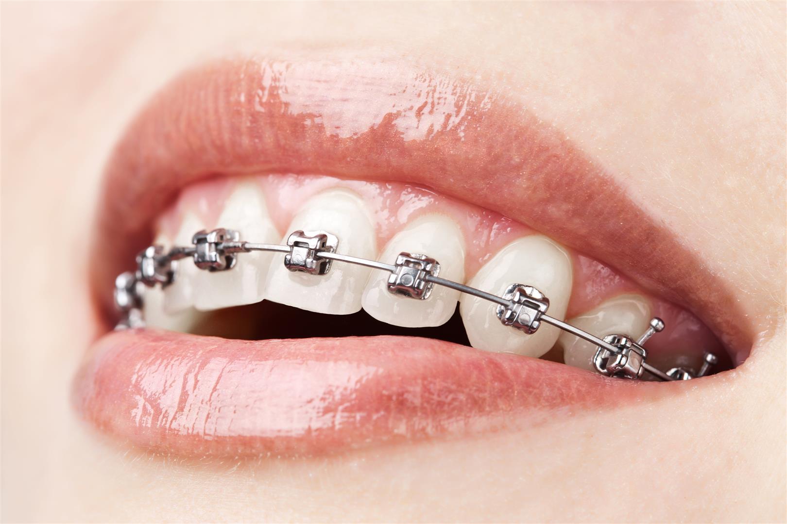 “orthodontie”的图片搜索结果