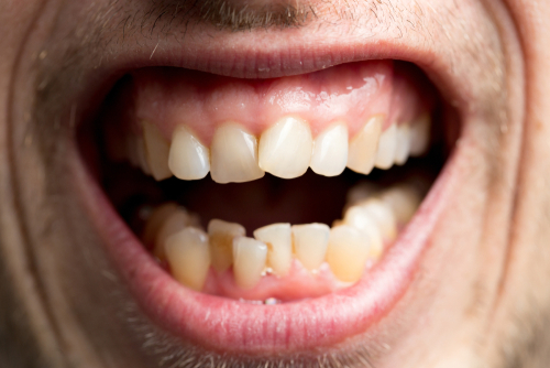 Le mauvais alignement des dents chez l'adulte - Helvident