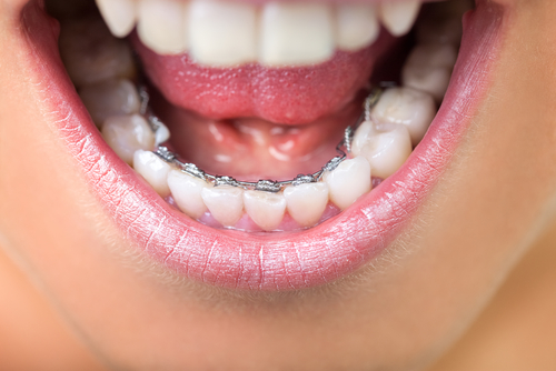 coffee rocket Pounding Orthodontie linguale: une solution discrète pour réparer le sourire