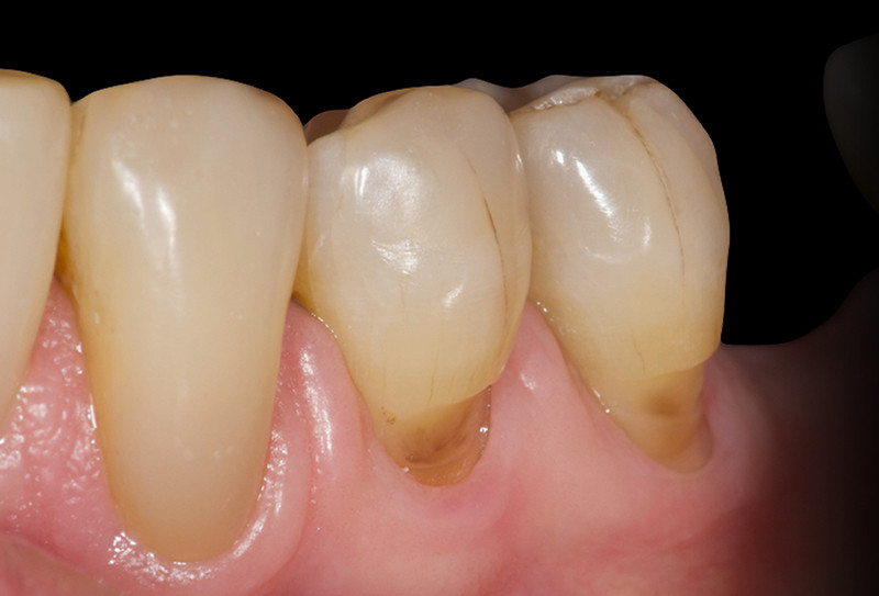 Déshydratation chronique et santé bucco-dentaire