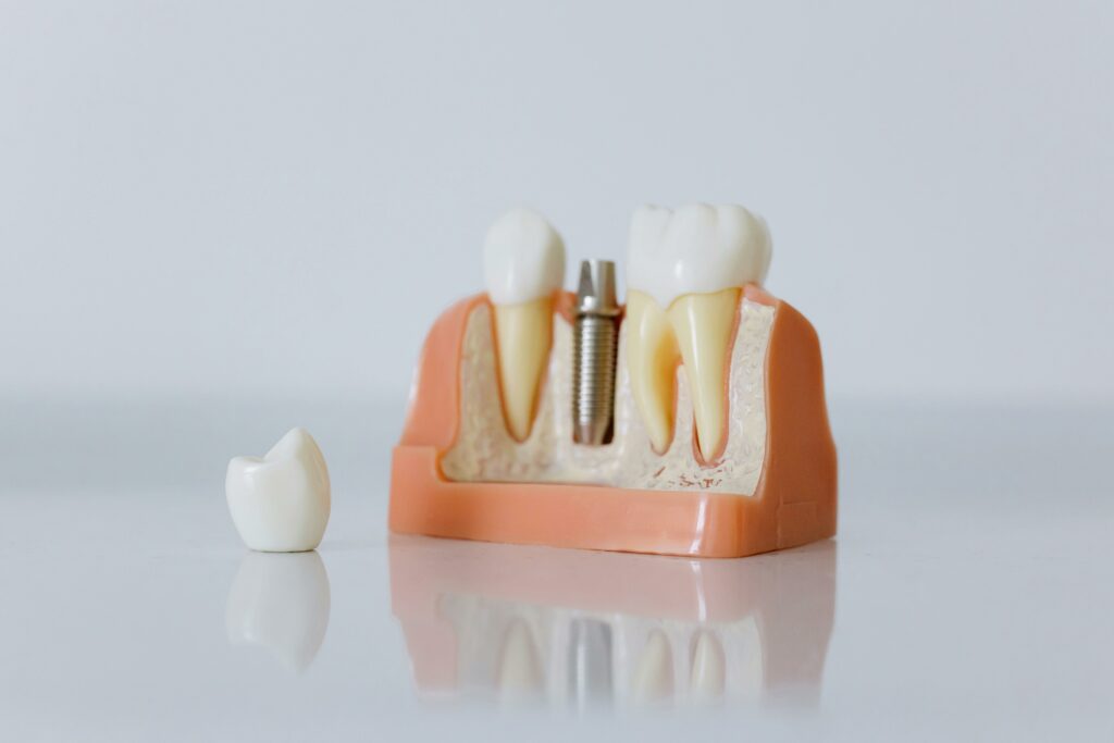 Implants Dentaires Low Cost
