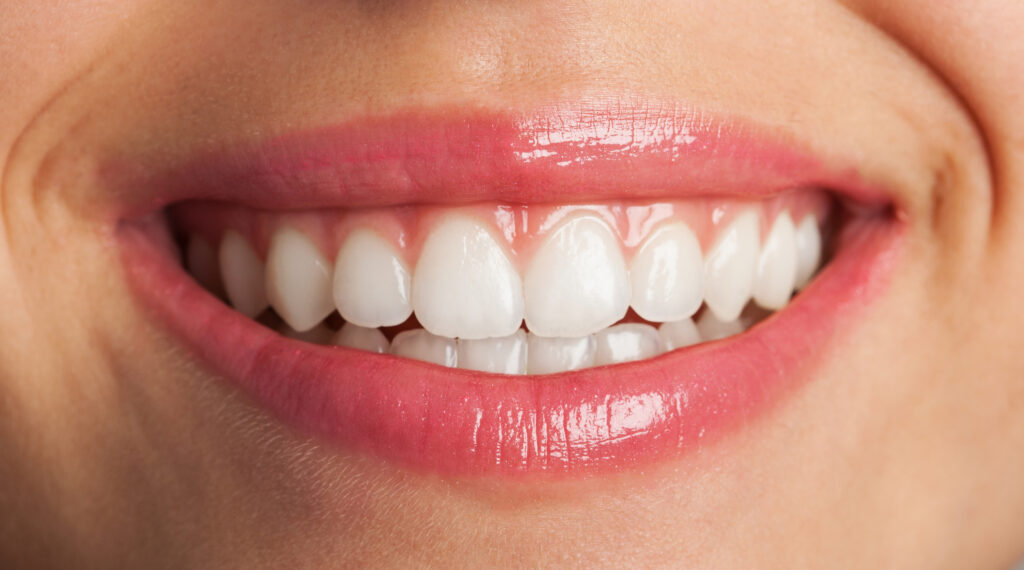 sourire gingival