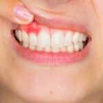 inflammation buccale chronique