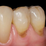 Déshydratation chronique et santé bucco-dentaire