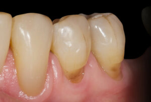 Déshydratation chronique et santé bucco-dentaire